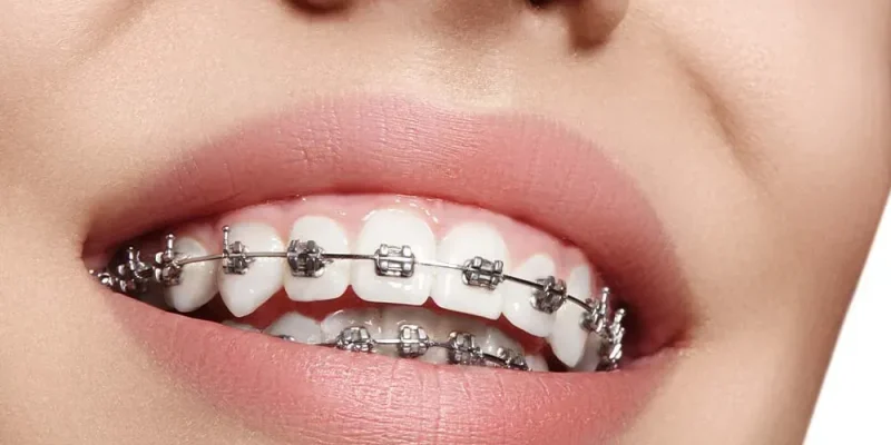 Metal Retainers