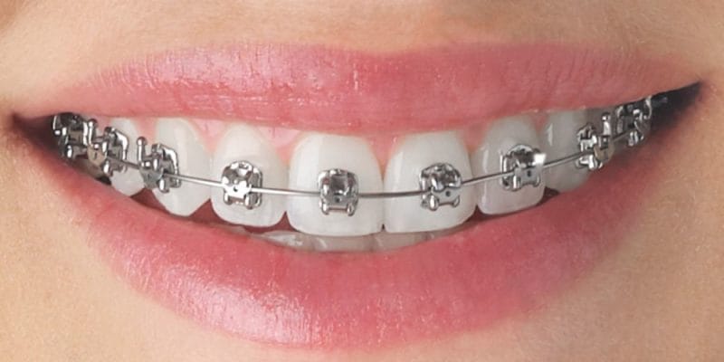 Orthodontic Treatment